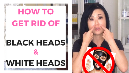 How to Get RID of Blackheads & Whiteheads