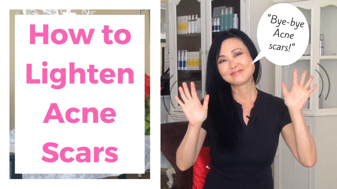 How To Lighten Acne Scars