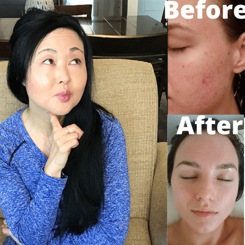 Best Acne Ingredients For Acne And Oily Skin