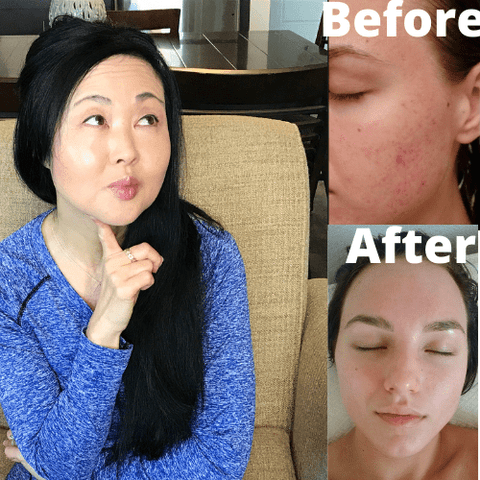 Benzoyl Peroxide Vs Salicylic Acid Vs Retinoids For Acne