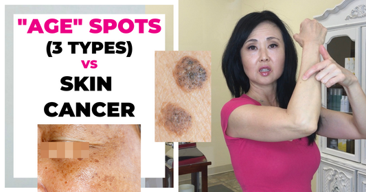 Age Spot Vs Skin Cancer