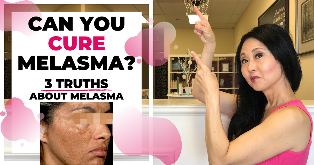 3 Truths Of Melasma-can You Cure Melasma?