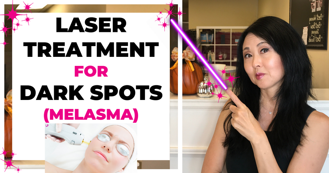 Laser Treatment For Melasma And Dark Spots