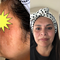 Melasma Treatment Before and After