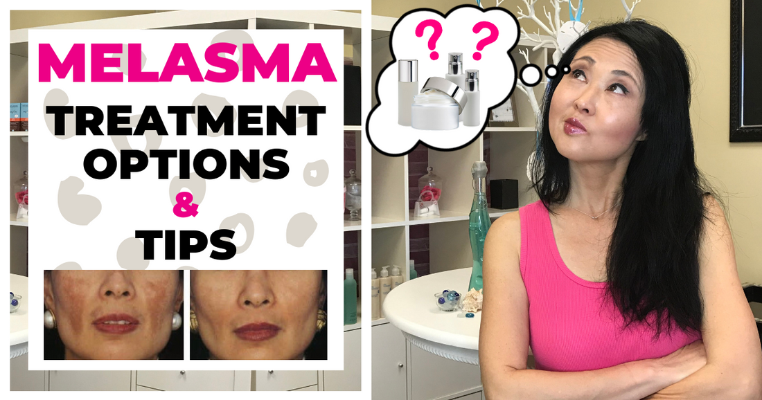 Best Treatment Options For Melasma