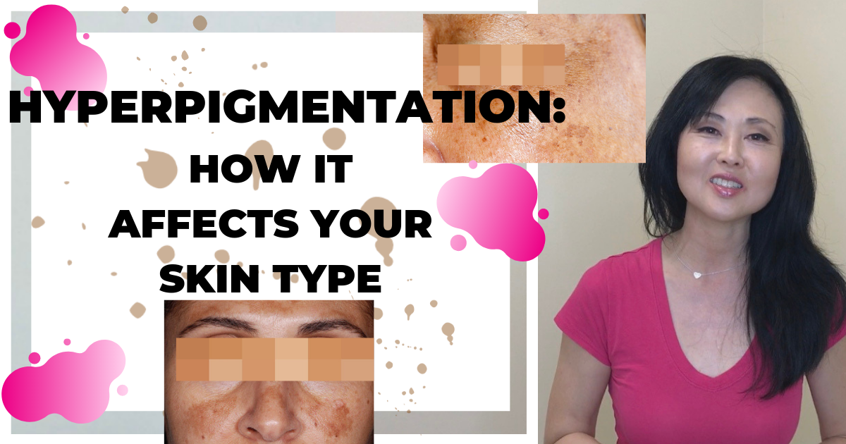 Hyperpigmentation Math Hyperpigmentation: Understanding how it affects your skin type – GSC BB