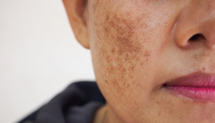 MELASMA TREATMENT PRODUCTS