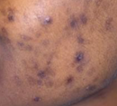 ACNE SCAR  TREATMENT CONSULTATION - GSC BB