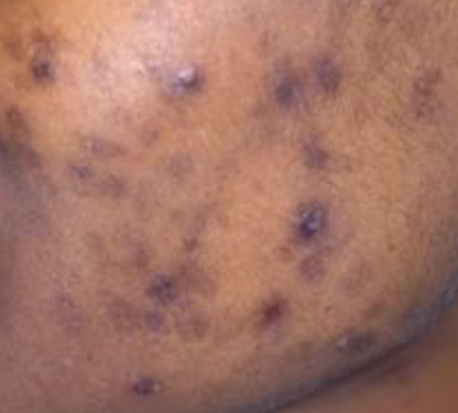 ACNE SCAR  TREATMENT CONSULTATION - GSC BB